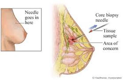 corebiopsy