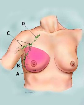 Mastectomy